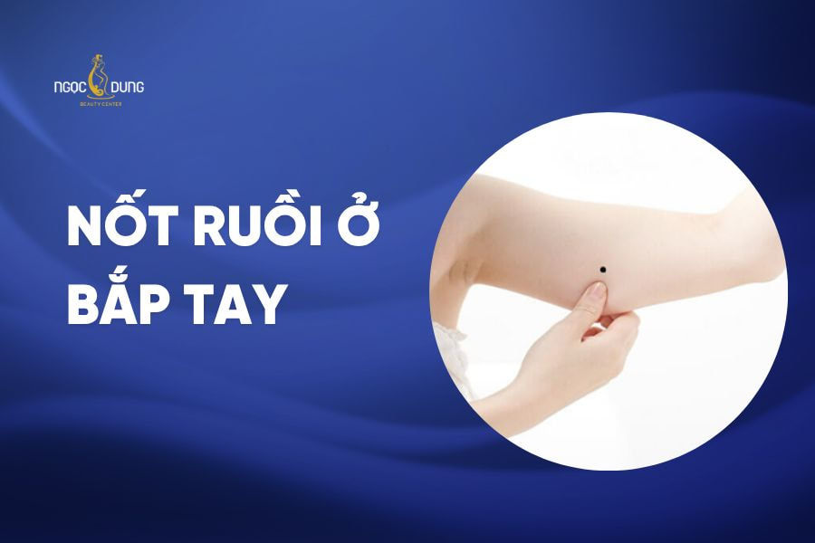 Nốt ruồi ở bắp tay