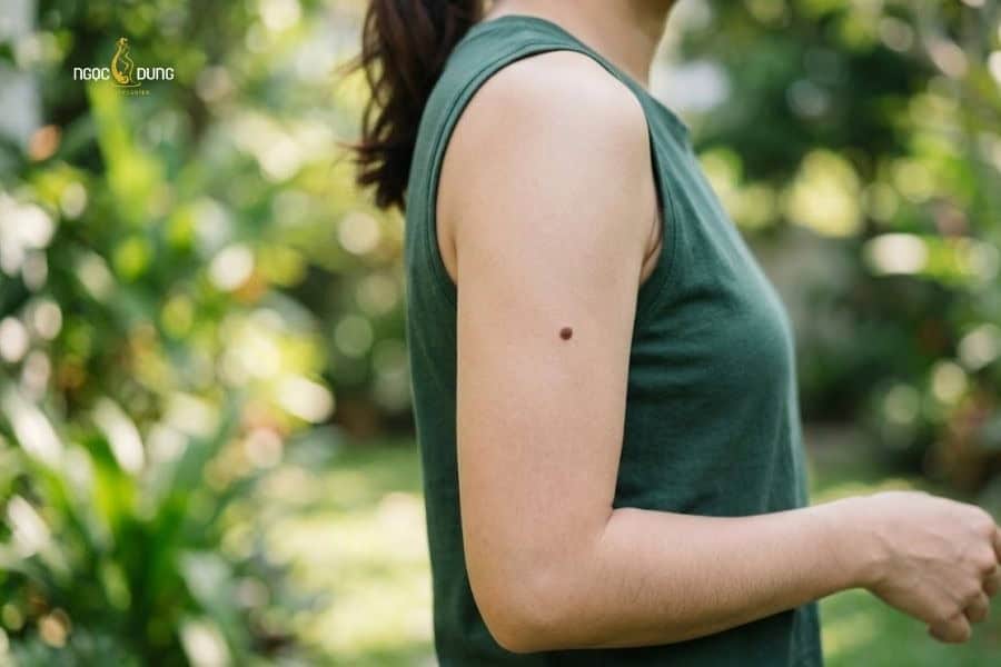 Người có nốt ruồi ở bắp tay thường có khả năng phát triển độc lập