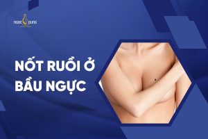 nốt ruồi ở bầu ngực