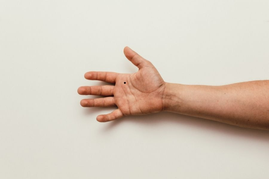 Nốt ruồi ở lòng bàn tay lầ hiện tượng sinh lý bình thường theo góc nhìn y học