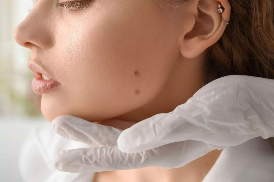 Di truyền và tiếp xúc với tia UV trong thời gian dài thường là yếu tố làm tăng nguy cơ xuất hiện nốt ruồi trên mặt
