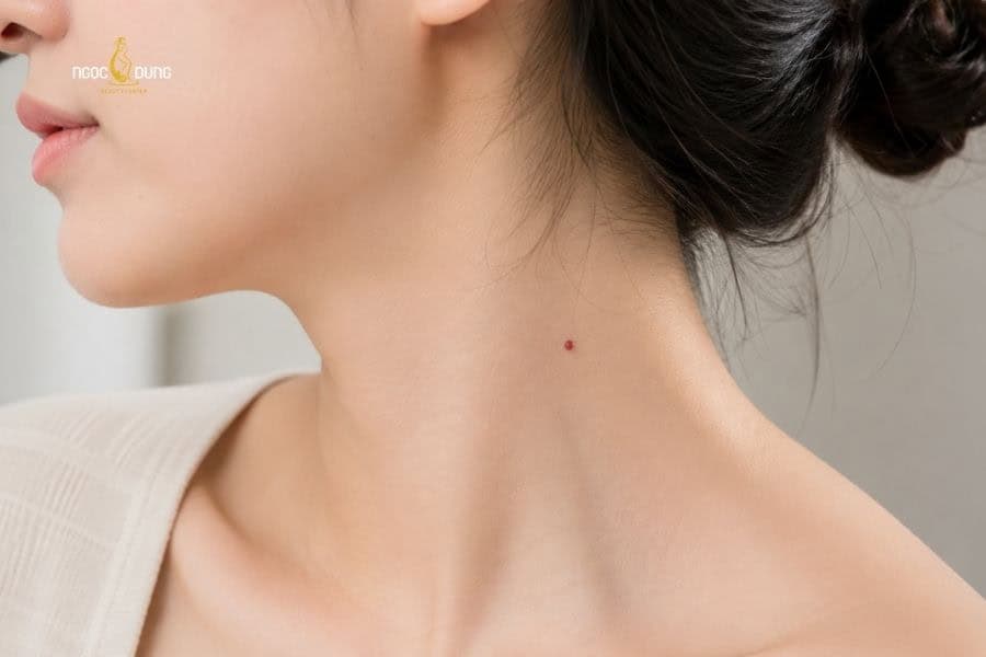 Nốt ruồi son ở cổ thường mang đến vận may về tài lộc cho người sở hữu
