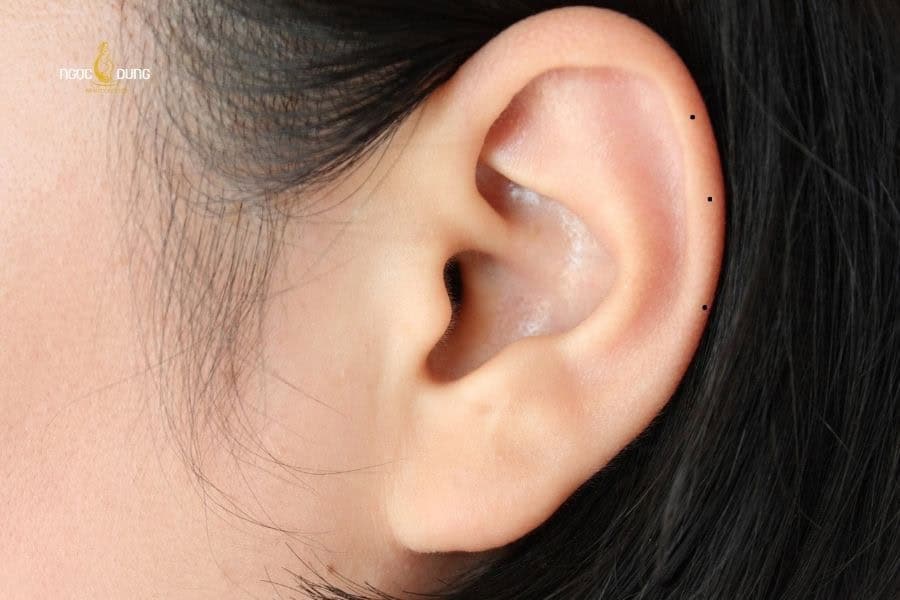 Nốt ruồi ở vành tai thường mang ý nghĩa về trí tuệ