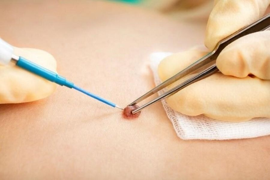 Việc quyết định phẫu thuật nên dựa trên chỉ định của bác sĩ chuyên khoa, tránh tự ý thực hiện tại các cơ sở không được cấp phép