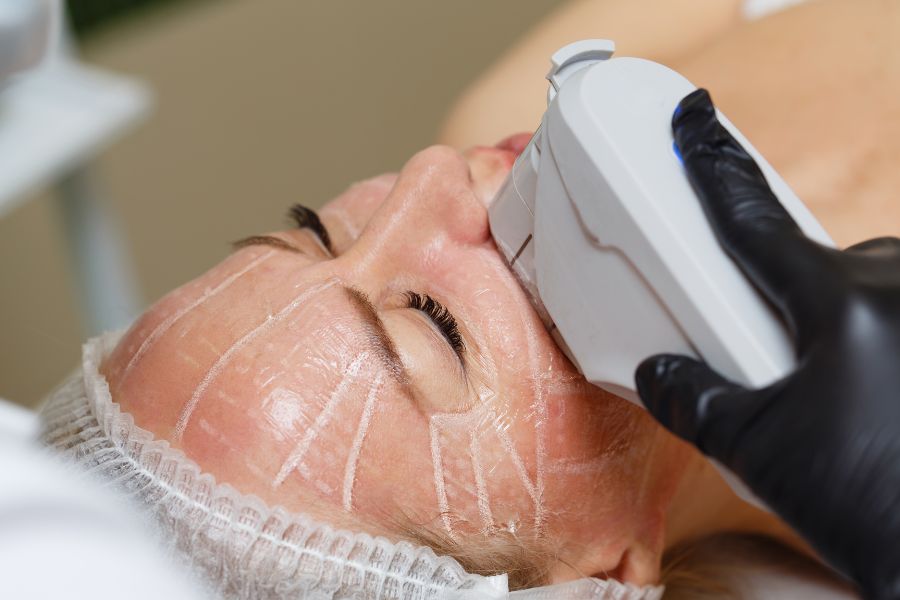 Sóng siêu âm hội tụ vi điểm sẽ hỗ trợ kích thích tăng sinh collagen và elastin