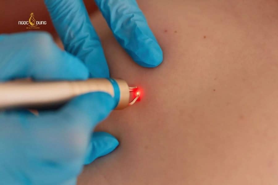 Tẩy nốt ruồi bằng Laser Fractional CO2 là phương pháp hiện đại nhất hiện nay