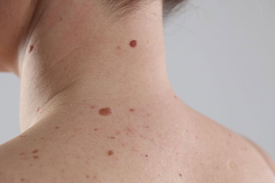 Cần đến thăm khám nếu có nốt ruồi gây ngứa hoặc có màu sắc kỳ lạ