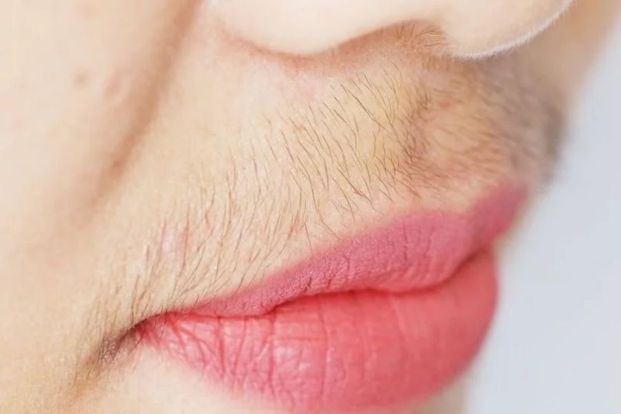Hãy triệt lông mặt nếu lông mọc rậm và sẫm màu