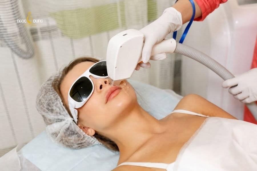 Có nên triệt lông mặt không? Các phương pháp hiệu quả 5 Triệt lông chuẩn y khoa sẽ vừa mang lại kết quả lâu bền vừa tránh kích ứng da