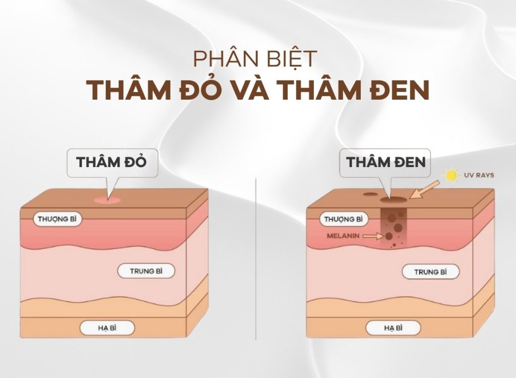 Phân biệt thâm đỏ và thâm đen để lựa chọn cách chăm sóc phù hợp