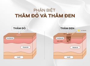 Phân biệt thâm đỏ và thâm đen để lựa chọn cách chăm sóc phù hợp