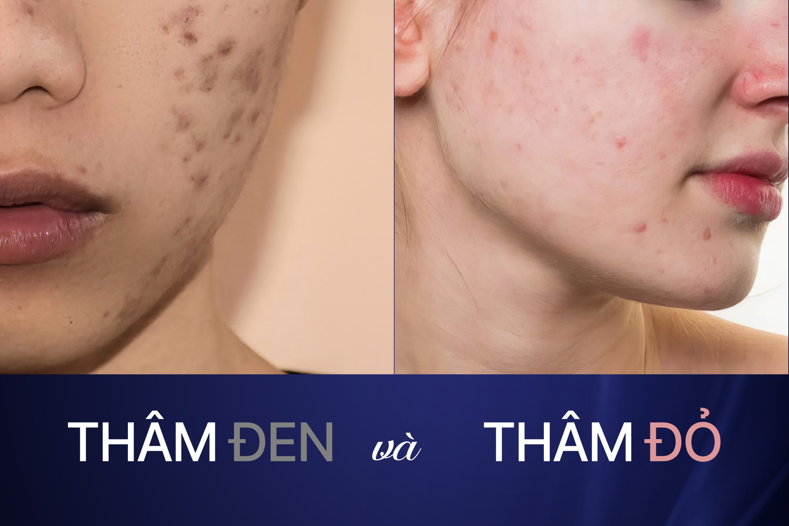 thâm đen và thâm đỏ