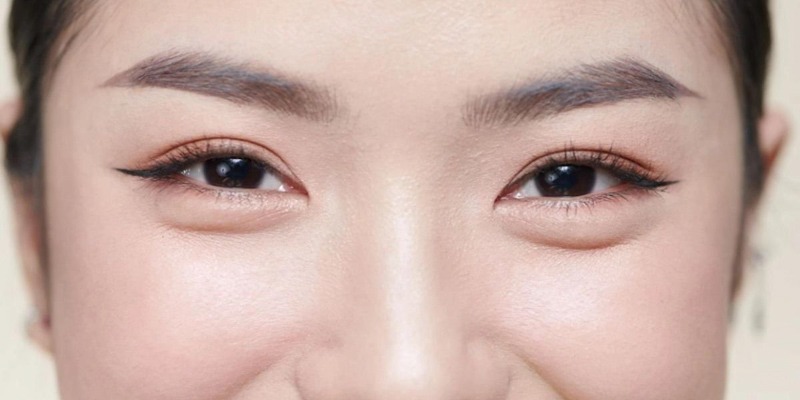 Nên điều trị bọng mắt sớm để lấy lại đôi mắt tươi trẻ