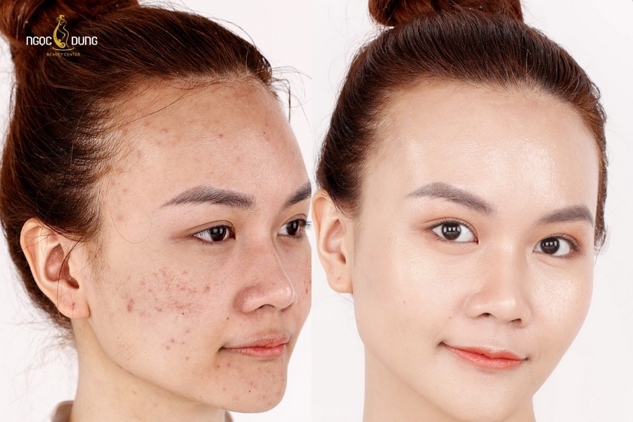 Thẩm mỹ viện Ngọc Dung sử dụng công nghệ cao để xóa mờ thâm đỏ và thâm đen