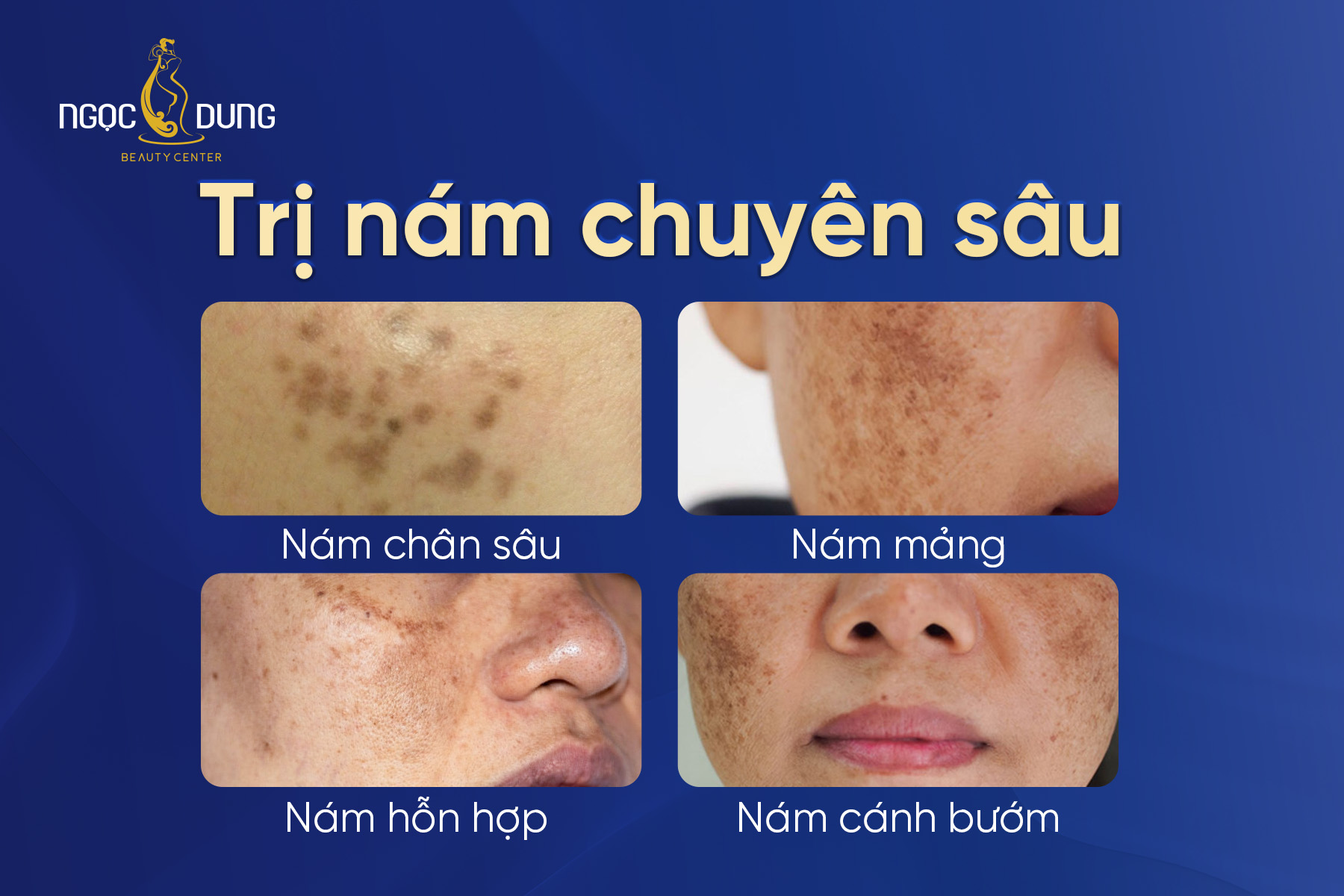 trị nám theo cơ chế kiểm soát melanin và tái tạo da chuyên sâu