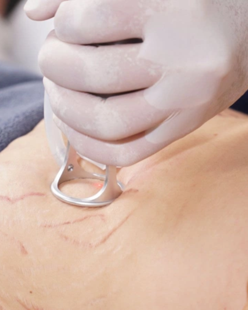 di tia laser tri ran da 1