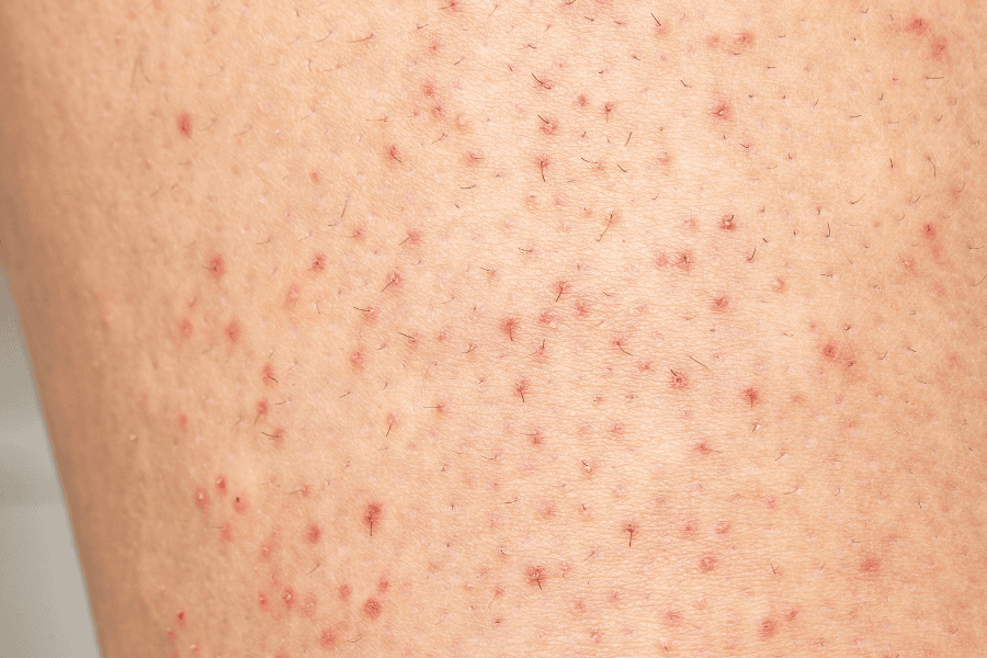 Triệt lông chân nam có hiệu quả không? Các phương pháp nên biết 14 Không nên tiến hành triệt lông khi đang bị viêm nang lông để tránh tổn thương da