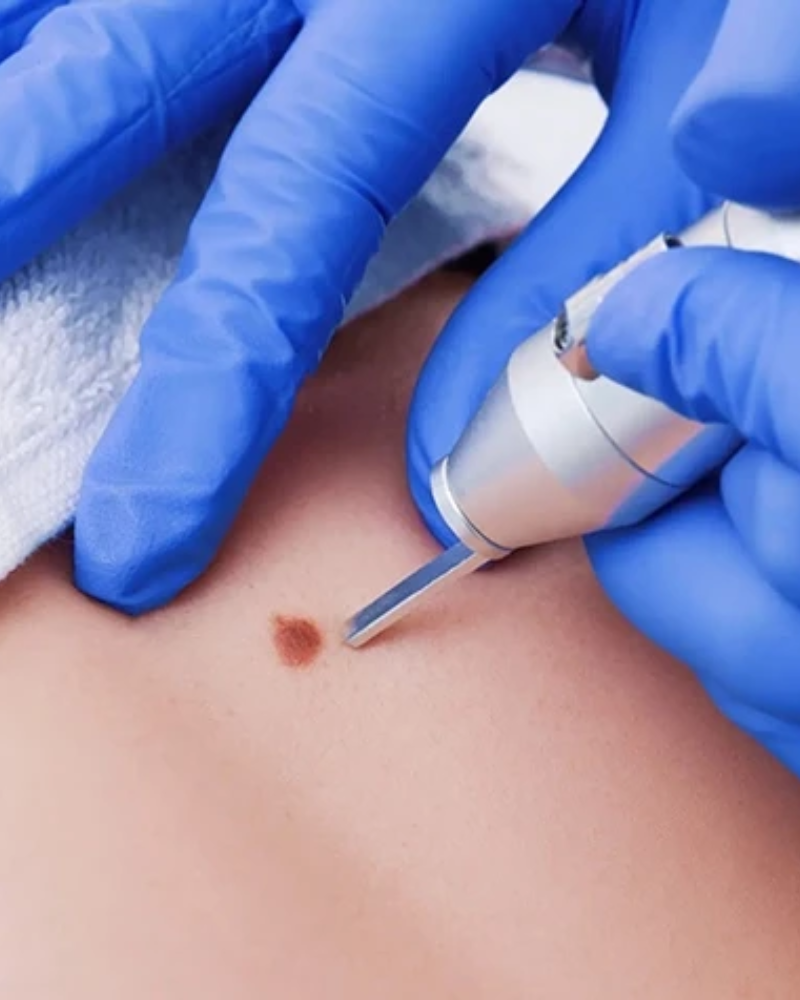 tay not ruoi voi laser