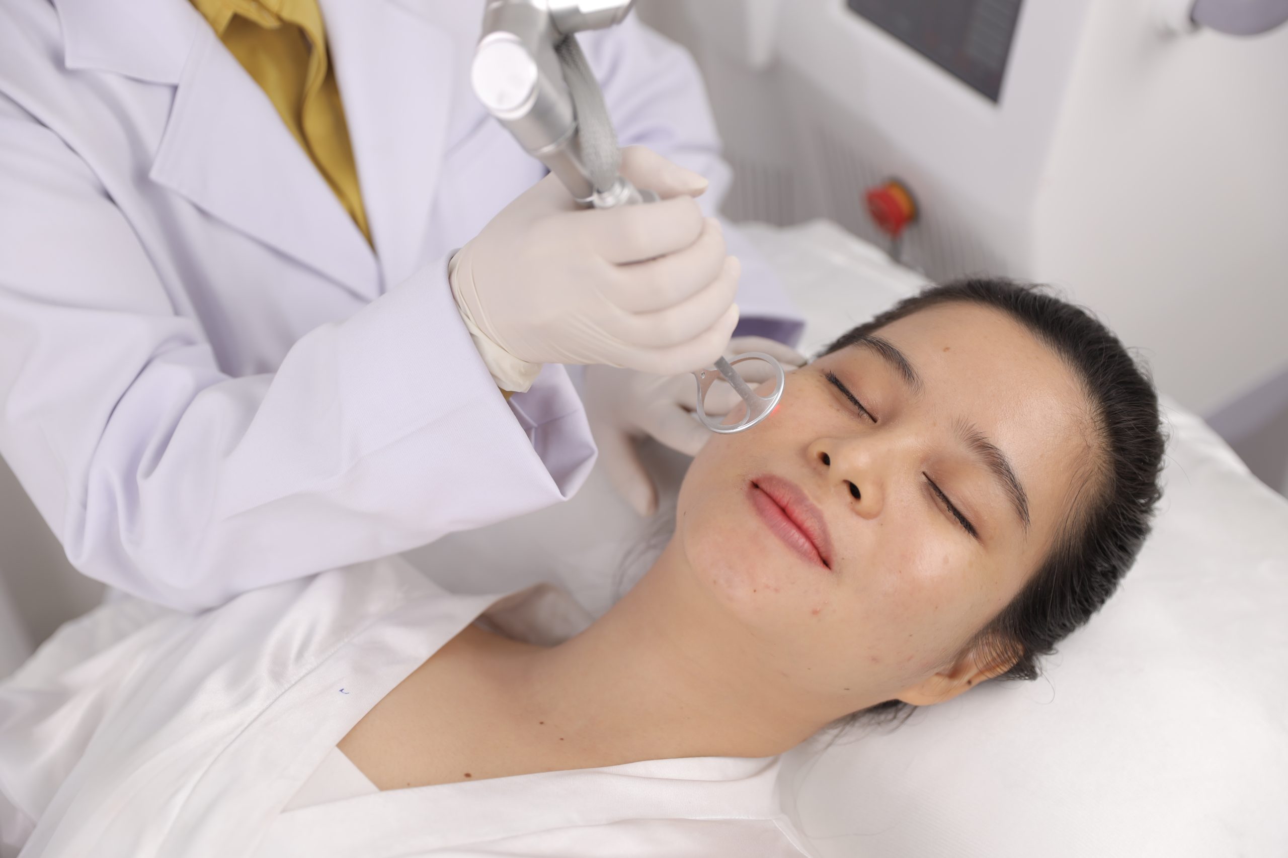 Trị sẹo rỗ cho da mịn màng