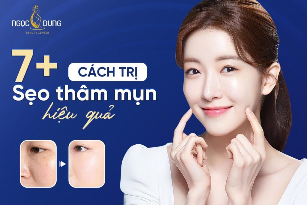 7 cách trị sẹo thâm mụn hiệu quả nhất hiện nay