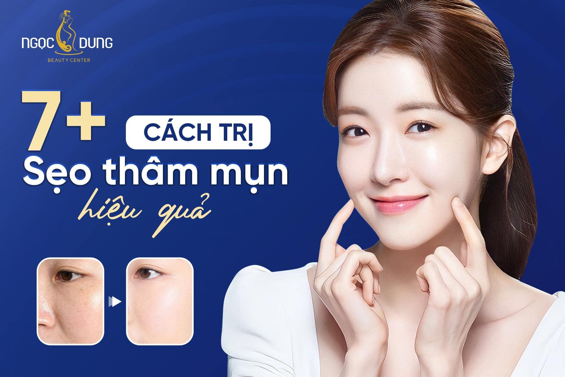 7 cách trị sẹo thâm mụn hiệu quả nhất hiện nay