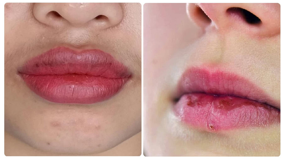 Xóa xăm tại nhà tiềm ẩn nhiều rủi ro