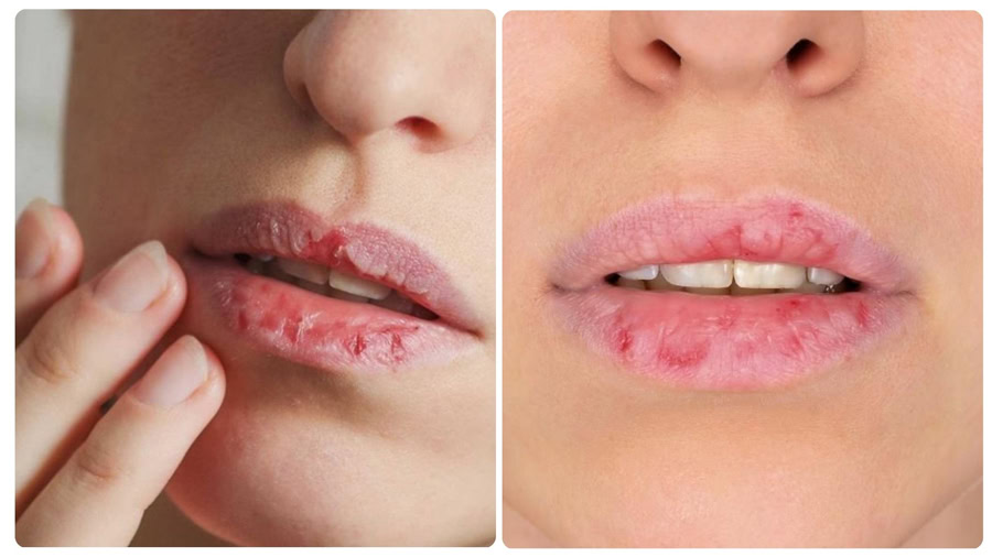 Môi sẽ hư tổn nhiều hơn nếu xóa xăm sai cách