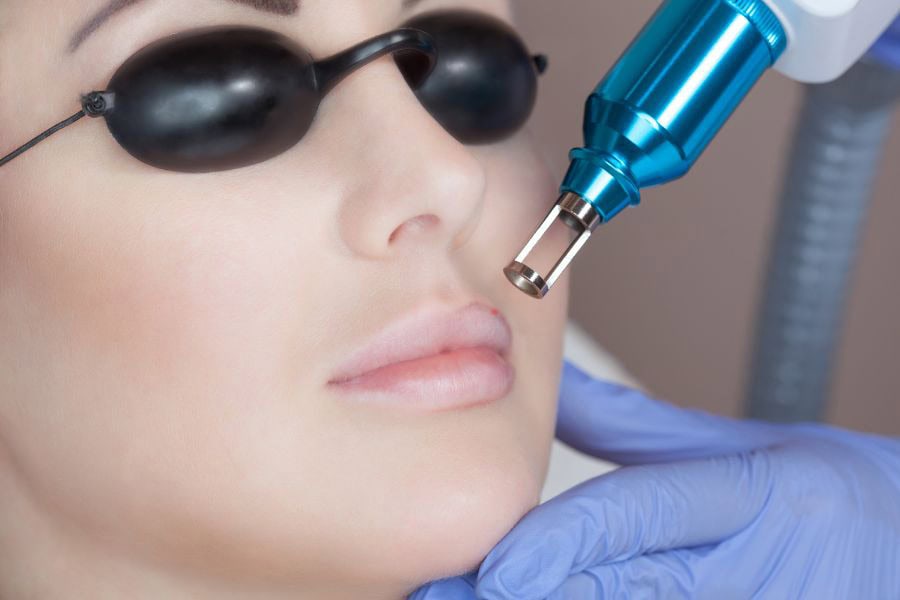 Muốn xóa xăm hoàn toàn cần áp dụng công nghệ chuyên sâu