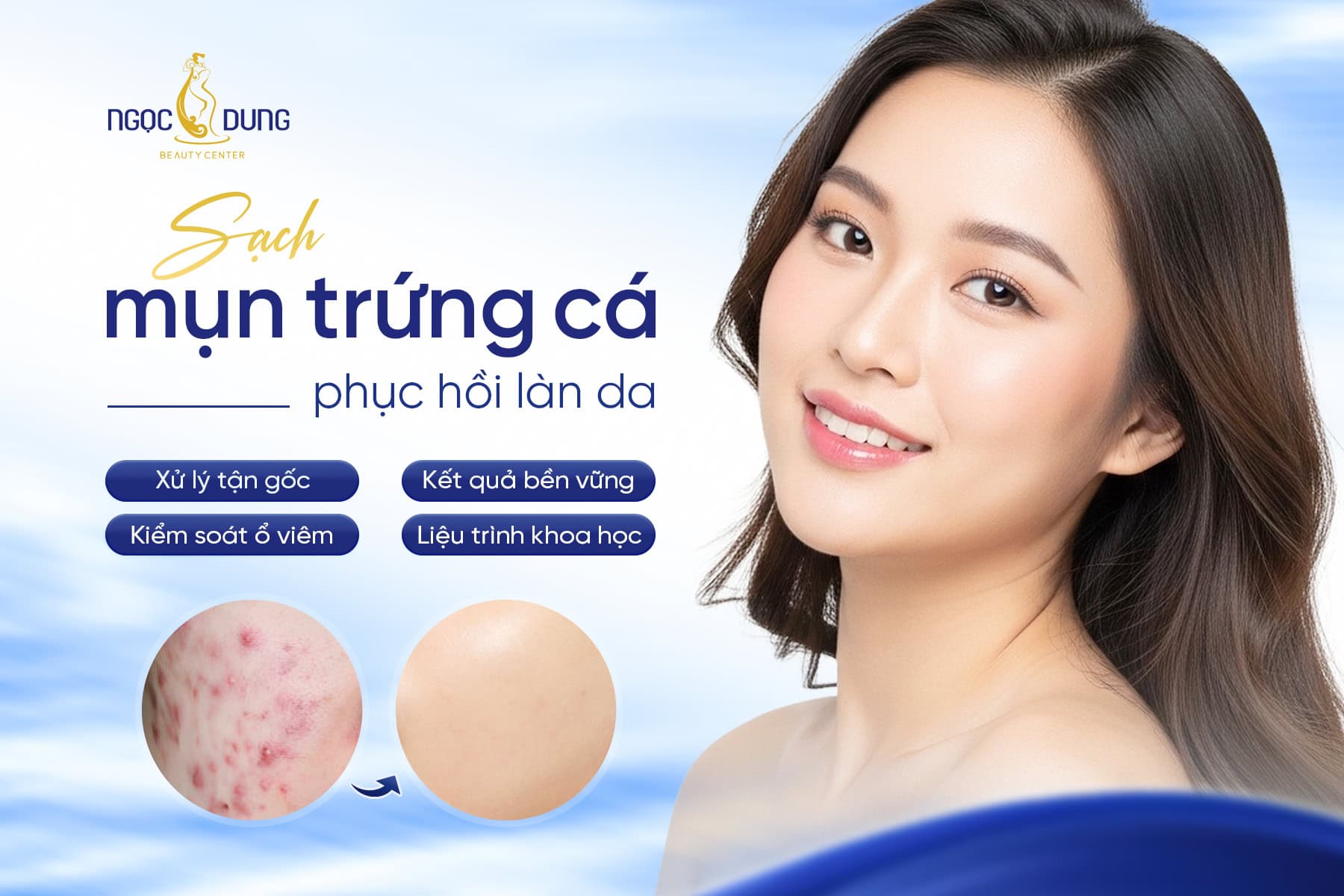 Trị mụn trứng cá bằng công nghệ cao giúp da sạch mụn và đều màu