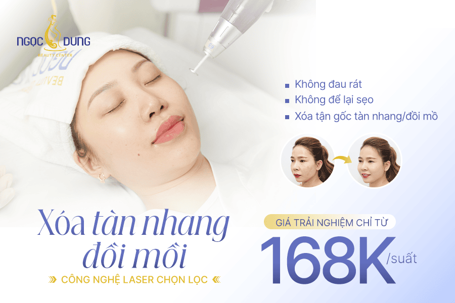 Trị tàn nhang dứt điểm với Laser thế hệ mới