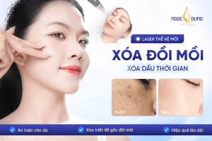 Trị đồi mồi xóa dấu thời gian hiệu quả
