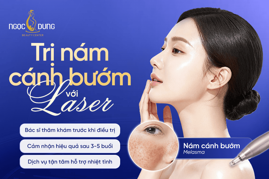 Trị nám cánh bướm chuyên sâu với Laser