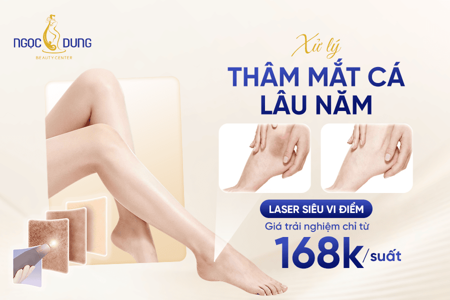 Trị thâm mắt cá chân hiệu quả giúp bạn tự tin diện sandal mỗi ngày