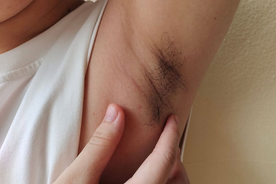 Nhiều chị em tìm kiếm cách để lông nách tự rụng