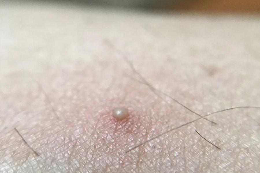 Lông nách mọc ngược gây viêm và đau nhức