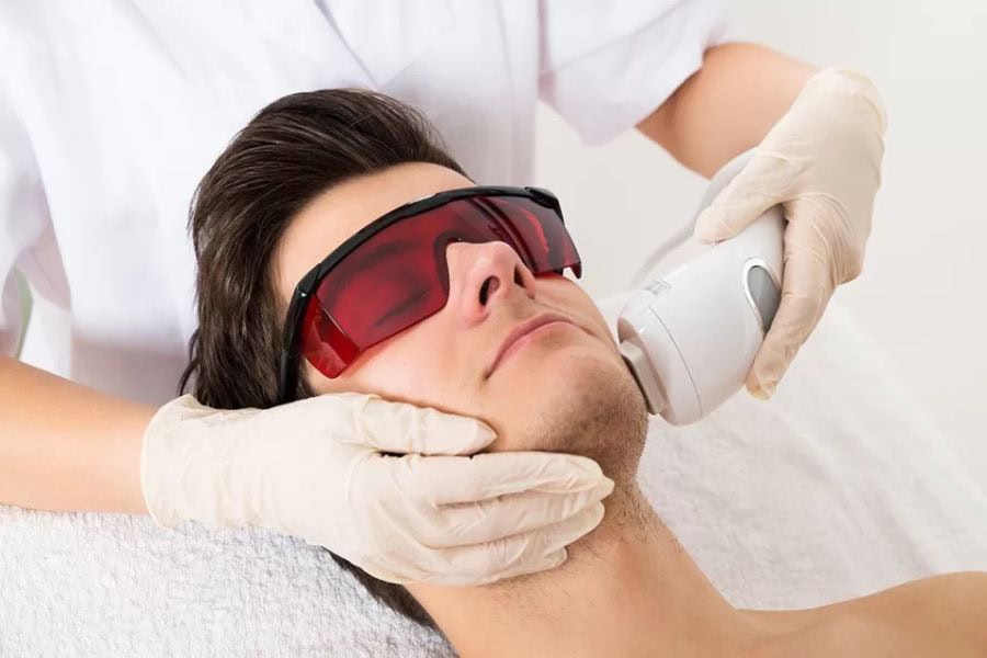 Cách triệt râu quai nón: Tại nhà có hiệu quả không? 10 Triệt râu quai nón bằng Laser được đánh giá cao