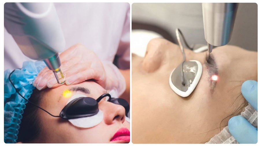 Sử dụng công nghệ cao để xóa xăm chân mày tại Thẩm mỹ viện Ngọc Dung