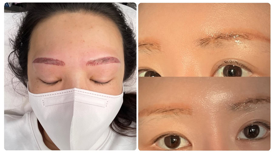 Không nên xóa xăm nếu chân mày đang bị kích ứng