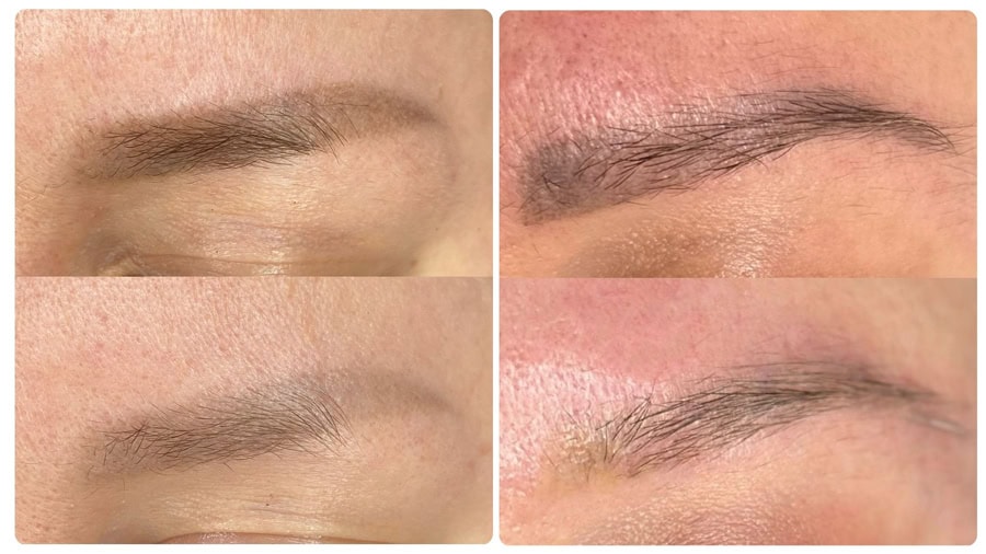 Xóa xăm tại nhà màu mực chỉ có thể mờ nhẹ