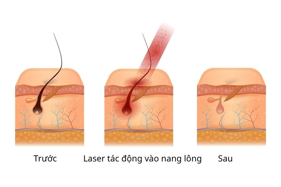 Cơ chế triệt lông bằng Laser​ là làm suy yếu gốc nang lông 