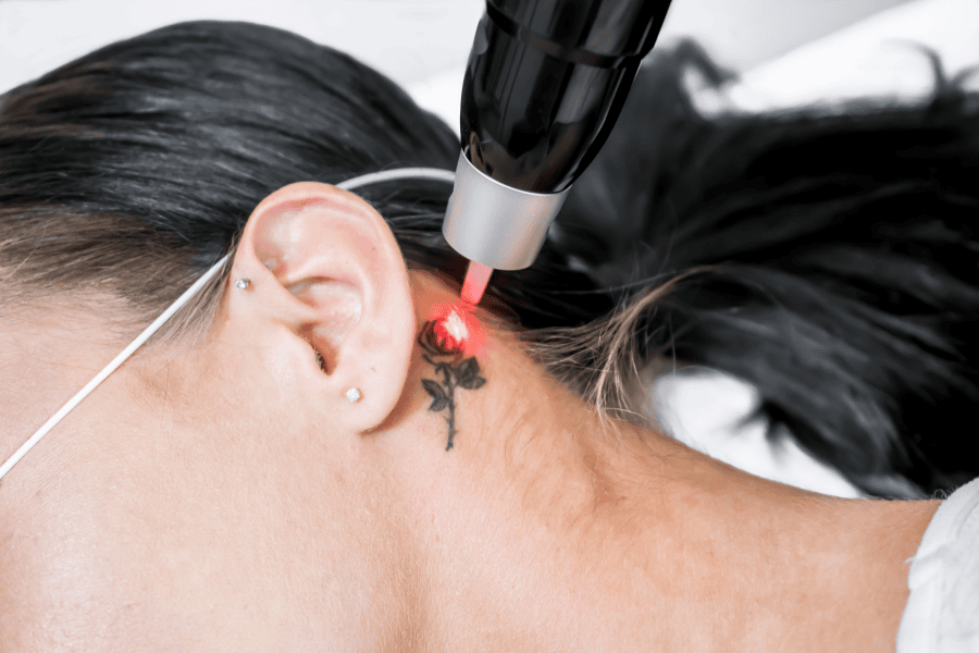 Laser Picosure là gì? Công nghệ điều trị nám và xóa xăm đỉnh cao 9 Công nghệ Laser Picosure giúp xóa những hình xăm phức tạp