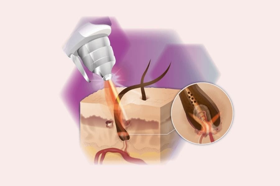 Triệt lông bằng Laser​ Nd:YAG 