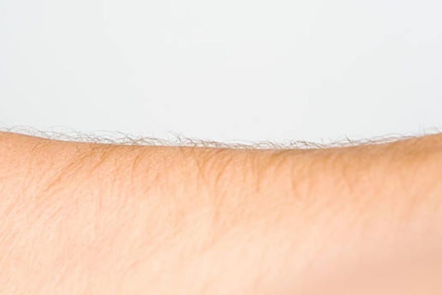 Người có lông sẫm màu và dày đặc biệt phù hợp triệt lông bằng tia Laser