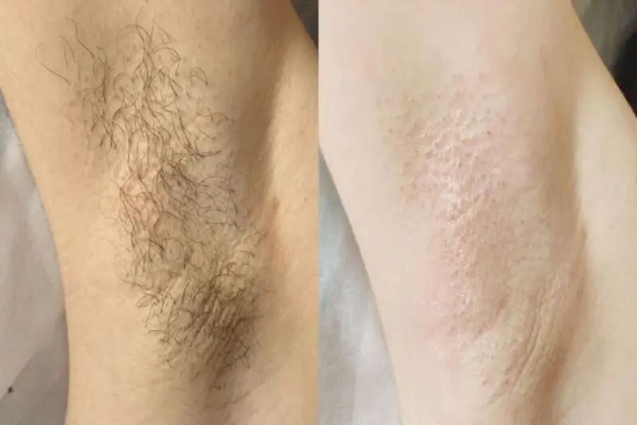 Giá triệt lông nách bao nhiêu? Bảng giá & chi phí mới nhất 2 Giá Triệt Lông Nách Bao Nhiêu? Bảng Giá & Chi Phí Liệu Trình Mới Nhất