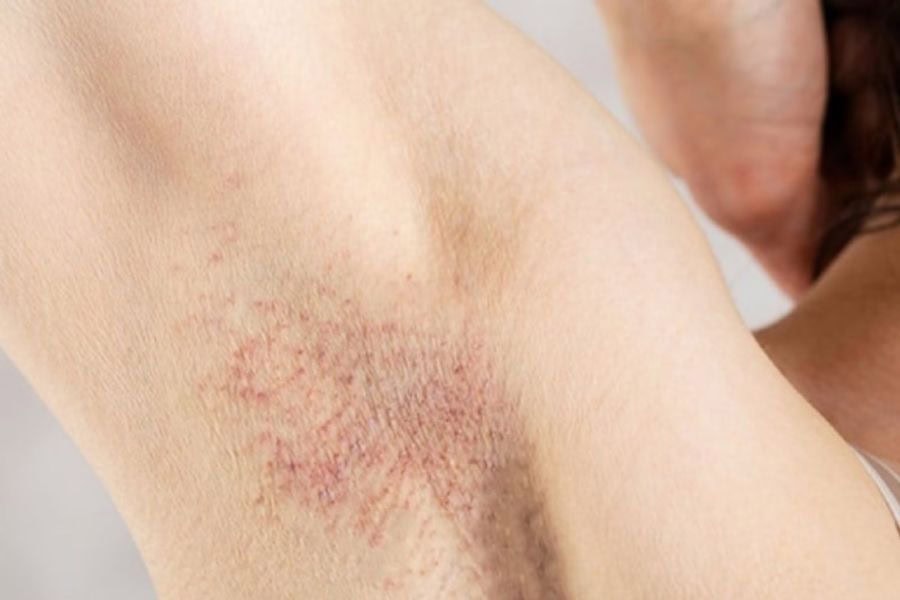 Giá triệt lông nách bao nhiêu? Bảng giá & chi phí mới nhất 10 Da đang viêm nang lông cần được tư vấn