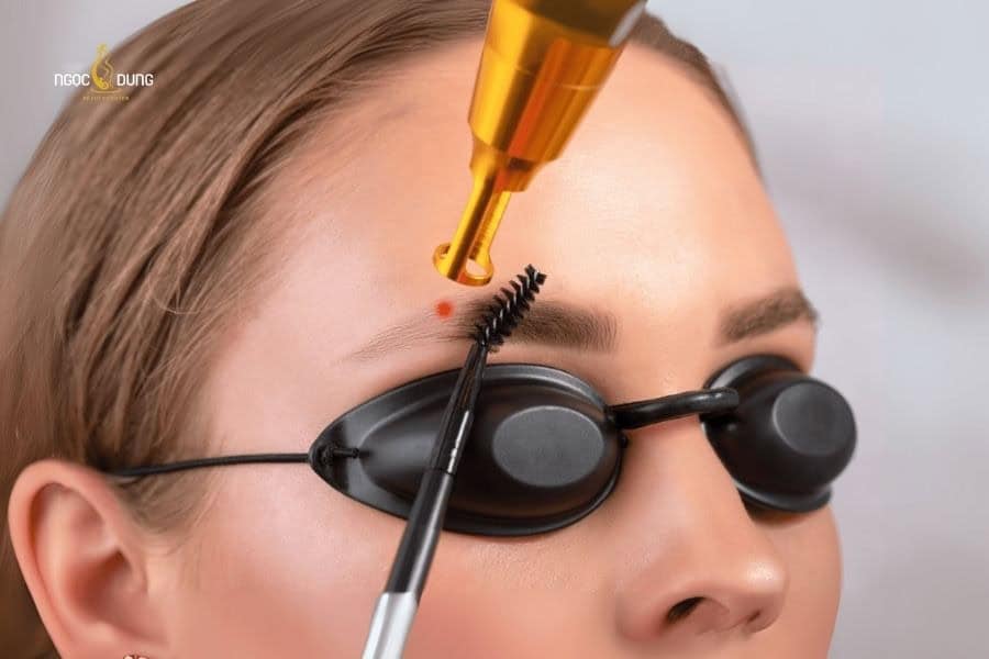 Cách xóa xăm chân mày tại nhà và những rủi ro cần biết 3 Xóa xăm lông mày hoàn toàn khả thi nếu bạn thực hiện tại cơ sở thẩm mỹ uy tín