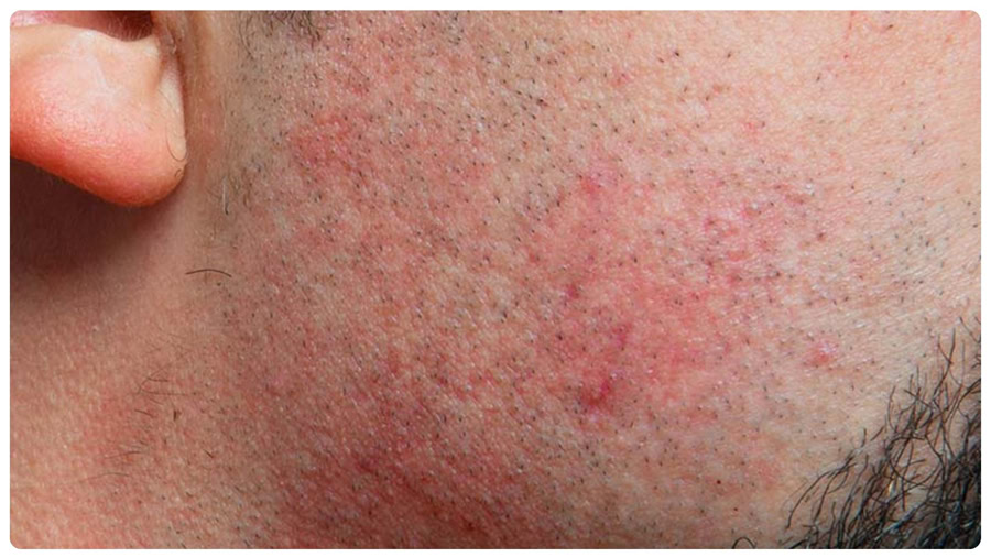 Kem triệt râu: Hiệu quả, so sánh và lưu ý quan trọng 11 Da nhạy cảm cần đặc biệt lưu ý khi chọn kem triệt râu cho nam