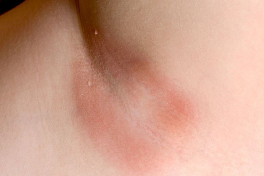 Không nên dùng thuốc tẩy lông nách khi da đang quá nhạy cảm