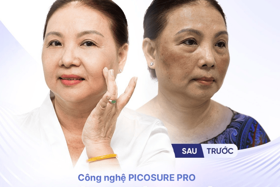 Laser Picosure là gì? Công nghệ điều trị nám và xóa xăm đỉnh cao 2 Laser Picosure là gì? Cơ chế hoạt động của công nghệ Laser Picosure