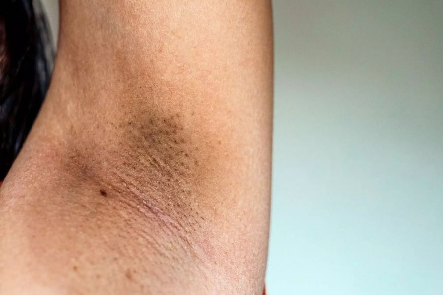 Da bị thâm sạm do nhổ lông nách thường xuyên